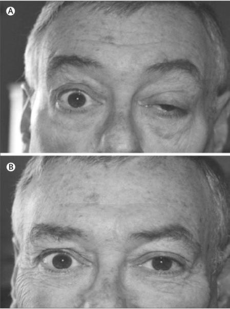 MG Examination: Ocular Findings Normal pupillary function Ptosis Generally asymmetric Sustained upgaze may worsen or elicit ptosis +/- ipsilateral frontalis muscle