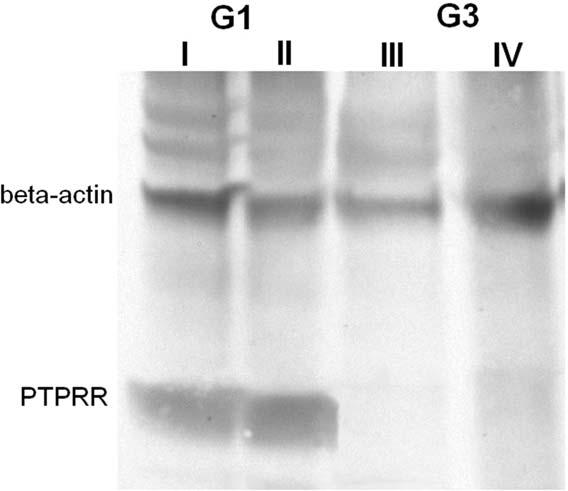 PROTEIN TYROSINE PHOSPHATASE RECEPTOR R AND Z1 EXPRESSION IN ORAL CANCER TABLE 4.