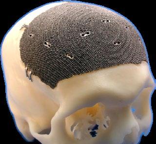 fusion implants can incorporate complex porous features.