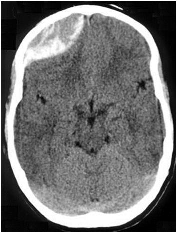 pdf Dura Mater Subdural Hematoma Arachnoid Mater Image source: https://commons.wiki media.org/wiki/file:in tracranial_bleed_with _significant_midline_s hift.