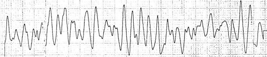 Brugada syndrome 221 Figure 1. Electrocardiogram taken by the ambulance team during cardiac arrest showing ventricular fibrillation A B Figure 2.