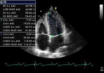 222 Holcman, et al. Discussion Figure 3. Transthoracic echocardiography.