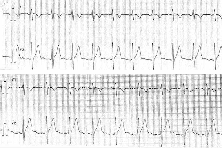 Brugada syndrome 223 A B Figure 4. Drug challenge with sodium channel blocker was performed.