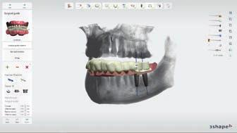 Luis Cuadrado, Spain Take advantage of seamlessly integrated digital workflows with 3Shape X1 scans and 3Shape implant and orthodontic software.