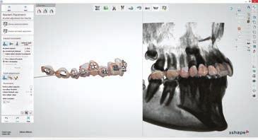 3Shape orthodontic solution complete digital solution for orthodontic clinics and laboratories Include X1 in your case studies for more efficient