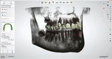 libraries and orthodontic solution providers 3Shape Implant Studio digital implant planning for improved predictability and better patient experience