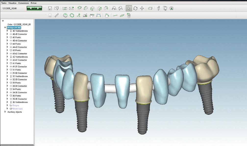 restorative dentistry Ease of use Easy and guided workflow Automatic design proposal and advanced tool for individual design options