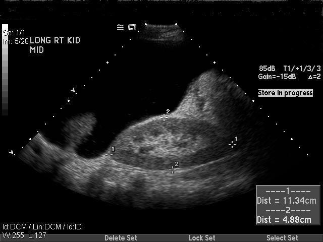 FIGURE 1. USG abdomen shows right kidney with hydronephrosis. FIGURE 2. USG abdomen shows right kidney with interval resolution of hydronephrosis. are seen in a wide variety of settings.