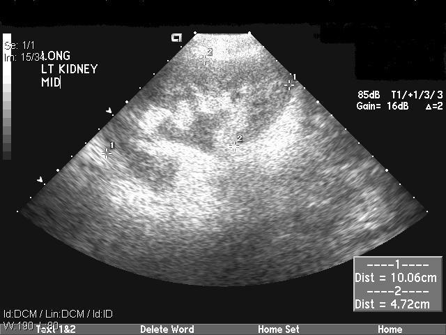 FIGURE 3. USG abdomen shows left kidney with hydronephrosis. FIGURE 4. USG abdomen showing interval resolution of hydronephrosis in left kidney.