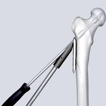 Due to the free rotation of the blade part relative to the shaft part, the DHS plate can be easily aligned to the femoral shaft.