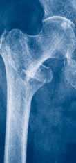 Clinical Cases Pertrochanteric fractures Special surgical considerations: Implant of choice Recent metanalysis has shown that the DHS