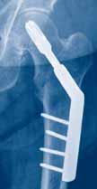 2, preoperative postoperative 3 month follow-up Femoral neck fractures Special surgical considerations: Implant of choice For unstable