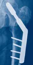 7 Nevertheless, operations of cervical hip fractures with a dynamic hip screw or three parallel screws seem to give similar clinical
