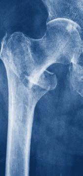 Clinical Cases Pertrochanteric fractures Special surgical considerations: Implant of choice Recent metanalysis has shown that the DHS tends to be