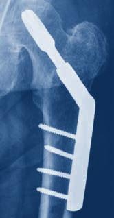 8 Emergency treatment A femoral neck fracture should be treated surgically within 6 hours of admission whenever possible.