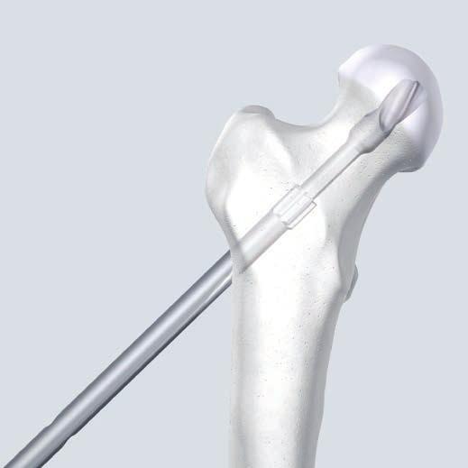 The blade is then removed with soft backward slide hammering on the extraction instrument. Warning: Never use the insertion instruments for implant removal.