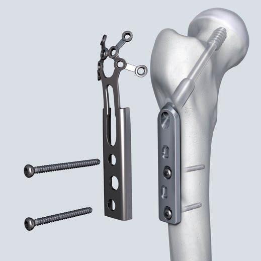 LTSP and ULTSP Implantation 2. Fix the LTSP/ULTSP onto the DHS plate Instruments 323.460 Universal Drill Guide 4.5/3.2 310.310 Drill Bit B 3.2 mm 319.
