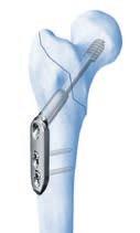 Fixates the greater trochanter, restoring the biomechanical function of the gluteus medius.