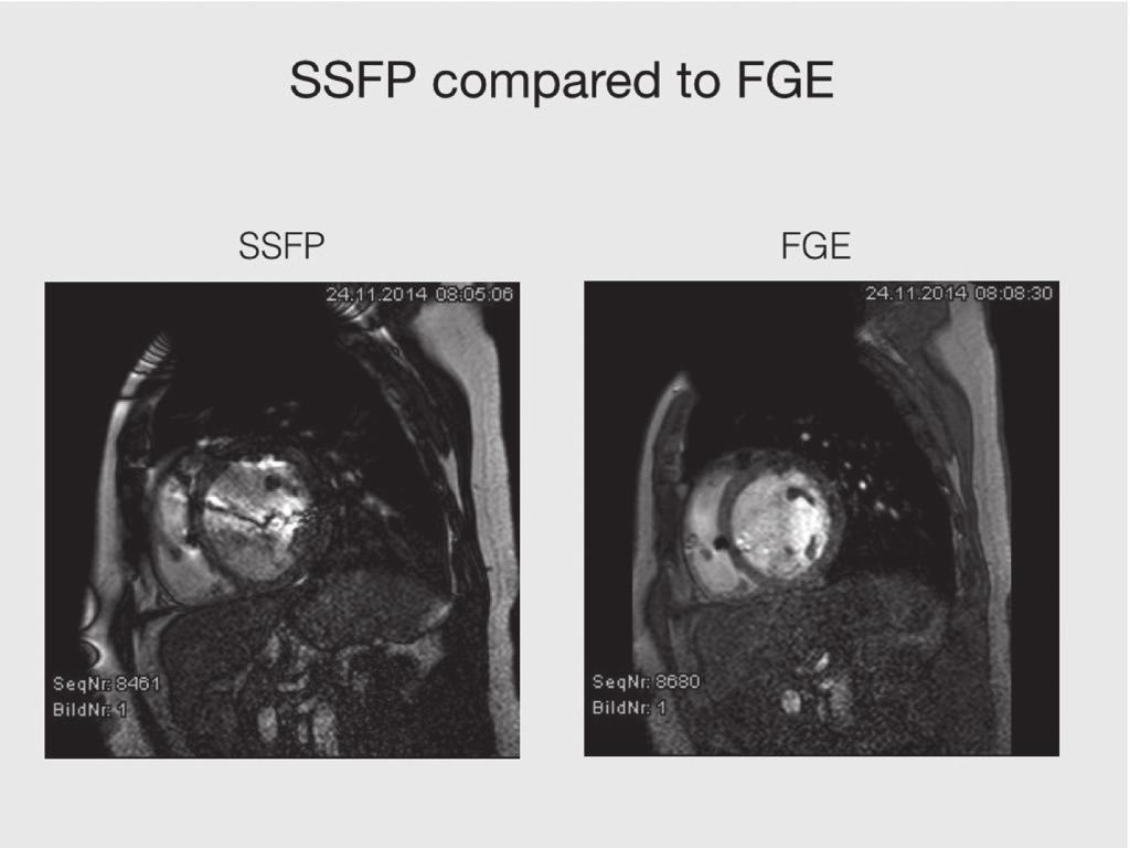 As is readily apparent, the use of an FGE sequence results in reduced susceptibility artifacts from the leads and the ICD device. reduced acquisition matrix, slightly larger FOV and a longer TE.