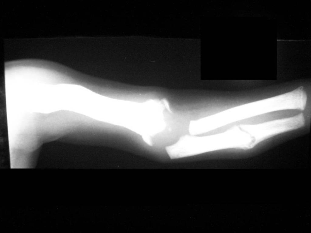 Fig. 13: Pathologic fracture in ulna, with