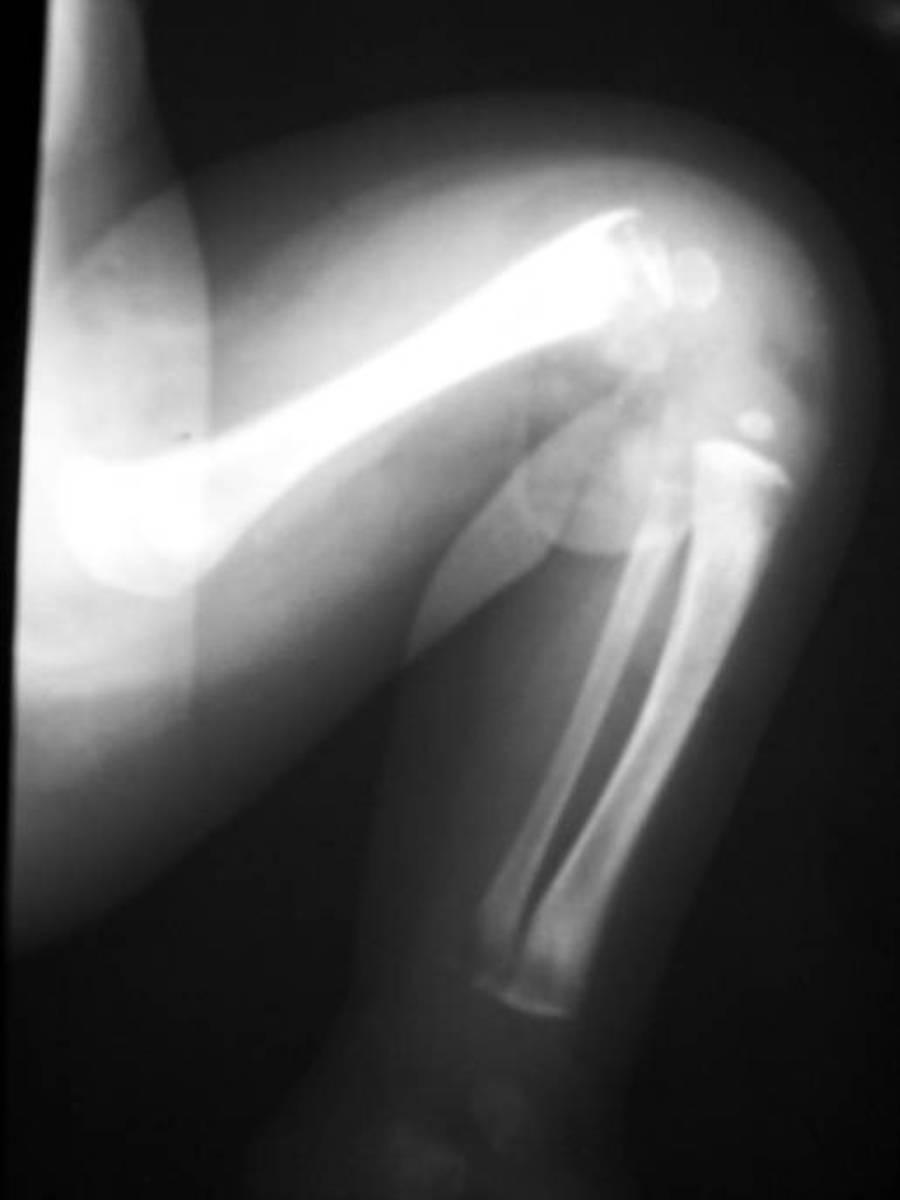 Fig. 16: Callus in distal femur with