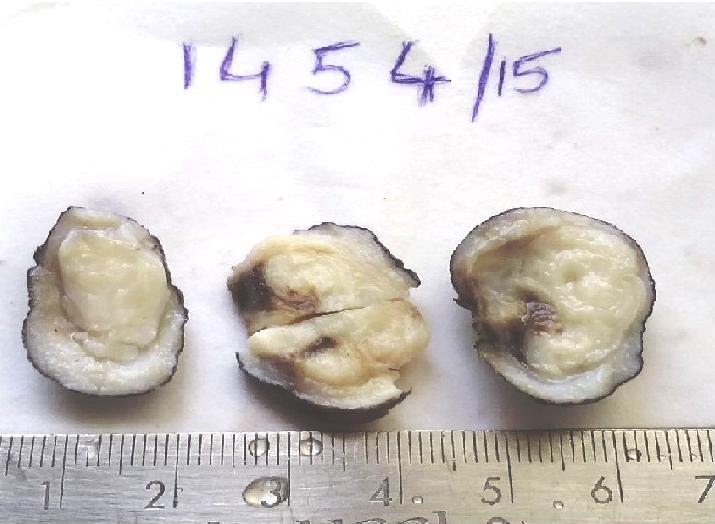 Fig:1- Examination of the surgical specimen revealed well-circumscribed globular mass measuring 2.5 cm in diameter covered with skin.