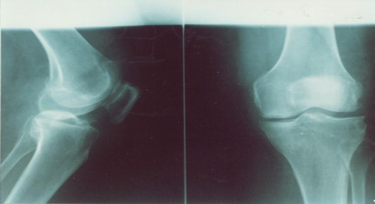 OA Figure (3): The X- rays for OA Osteoarthtic
