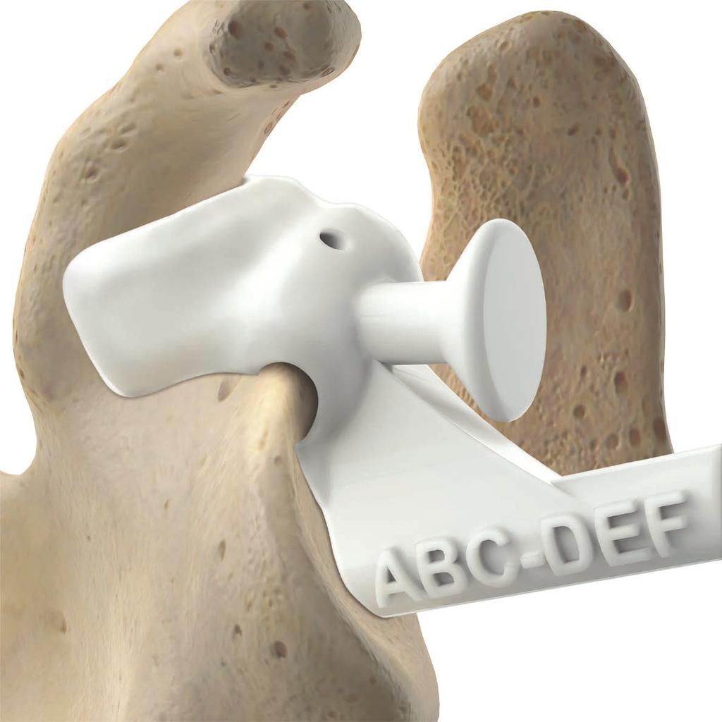 TrueSight guide placement Secure the guide onto your patient s glenoid by seating the coracoid clip onto the base of coracoid and verify that the