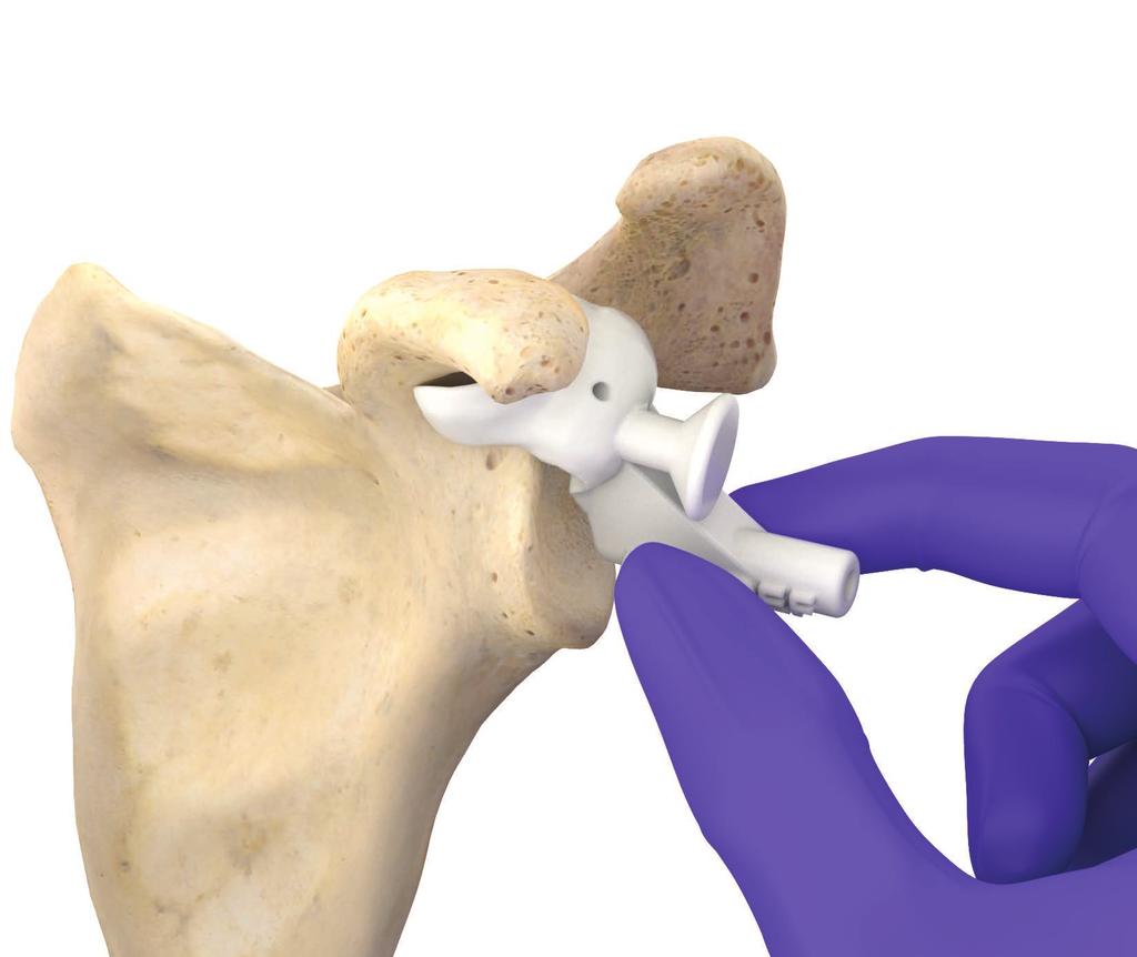 Check for gaps between the TrueSight guide and the glenoid anatomy to ensure a proper fit (Figure 5). Caution Do not alter the guide before use.