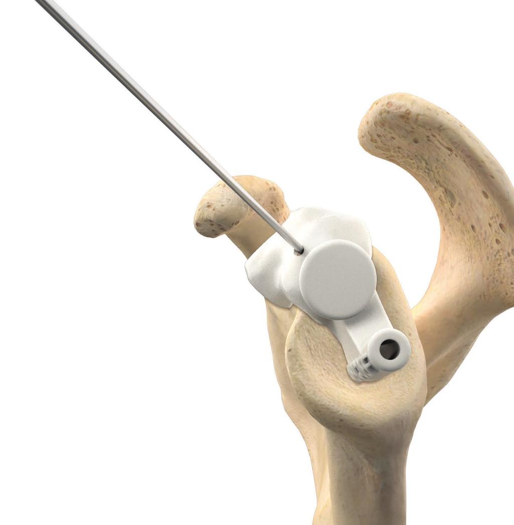 between the bottom of the 2mm labrum offset on the guide