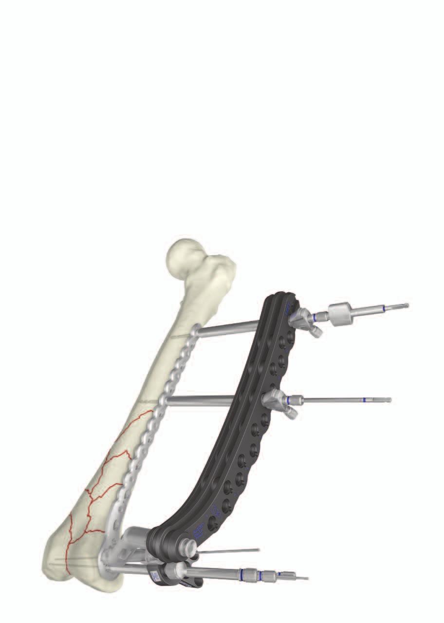 Features & Benefits System The Distal Lateral Femoral Plate is designed with optimized fixed-angled screw trajectories in the metaphyseal part and perpendicular fixed-angled screw trajectories in the