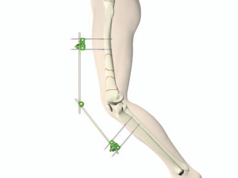 Reduction Anatomical reduction of the fracture should be performed either by direct visualization with the help of percutaneous clamps, or alternatively a bridging external fixator to aid with