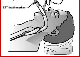 Intubating Through the LMA Use only ET tube provided Preoxygenate, verify ET cuff