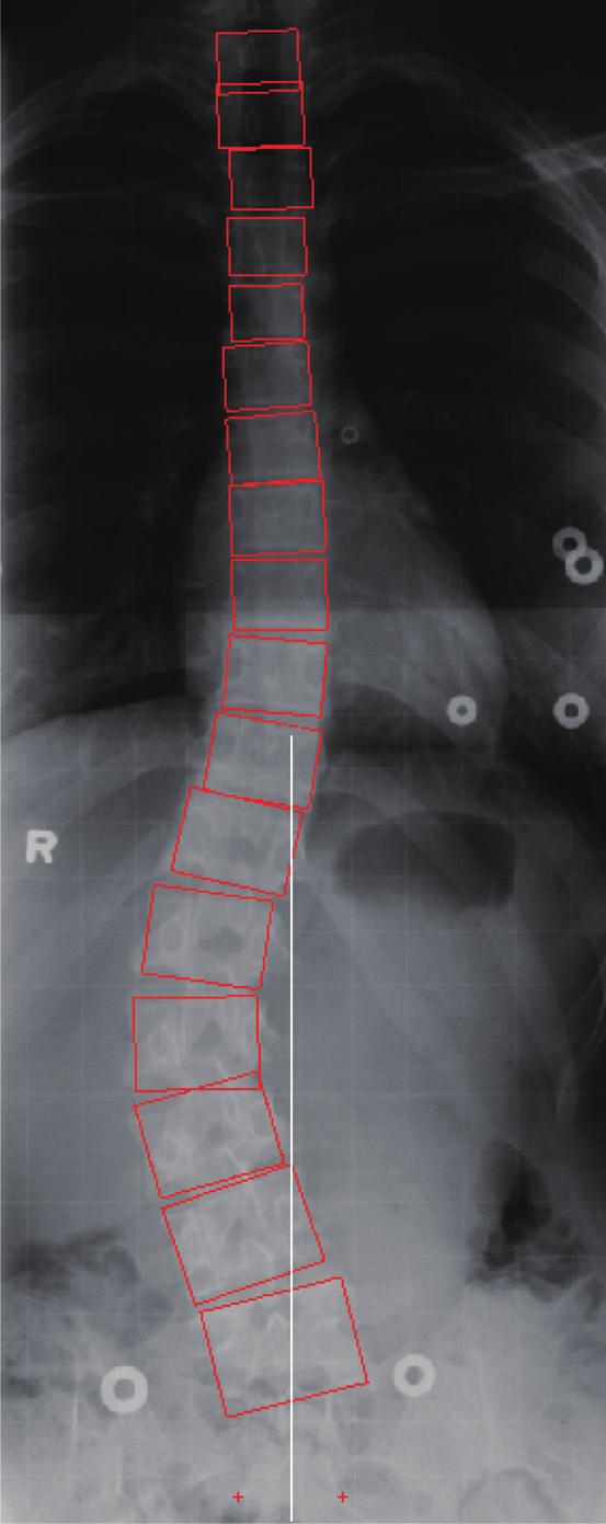 J. Zhang et al. / Computer-aided King classification of scoliosis S413 Fig. 1. ROI selection and landmark identification. Fig. 2. Detection of endplates. (a) ROI with the inner and outer rectangles.