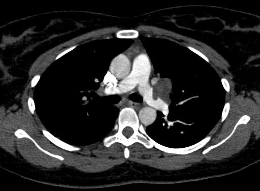 DIAGNOSTIC WORKUP Previous chest CT (pre