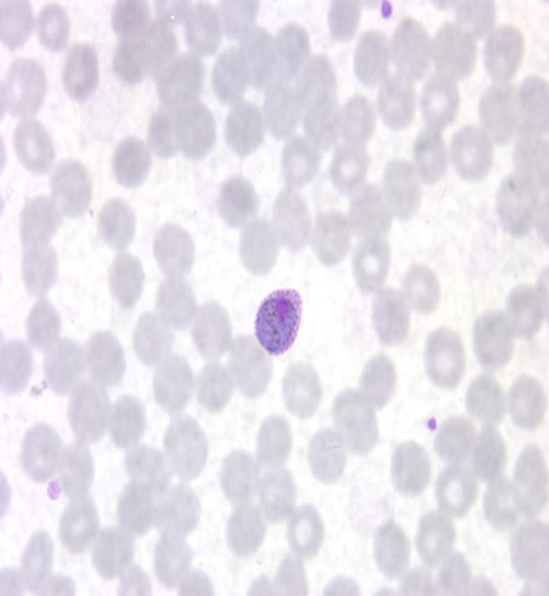 Malaria- P.