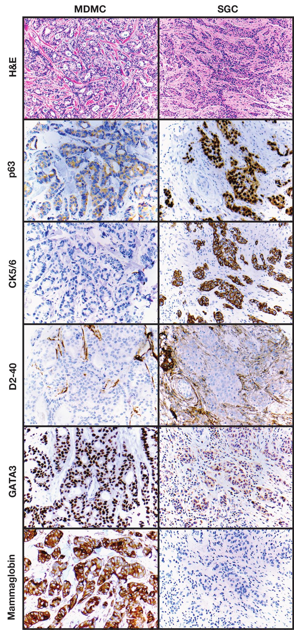 AJCP / Original Article compromised by its similar expression in 71% of primary SGCs, although labeling of those lesions was more patchy and tended to have at most moderate staining intensity.