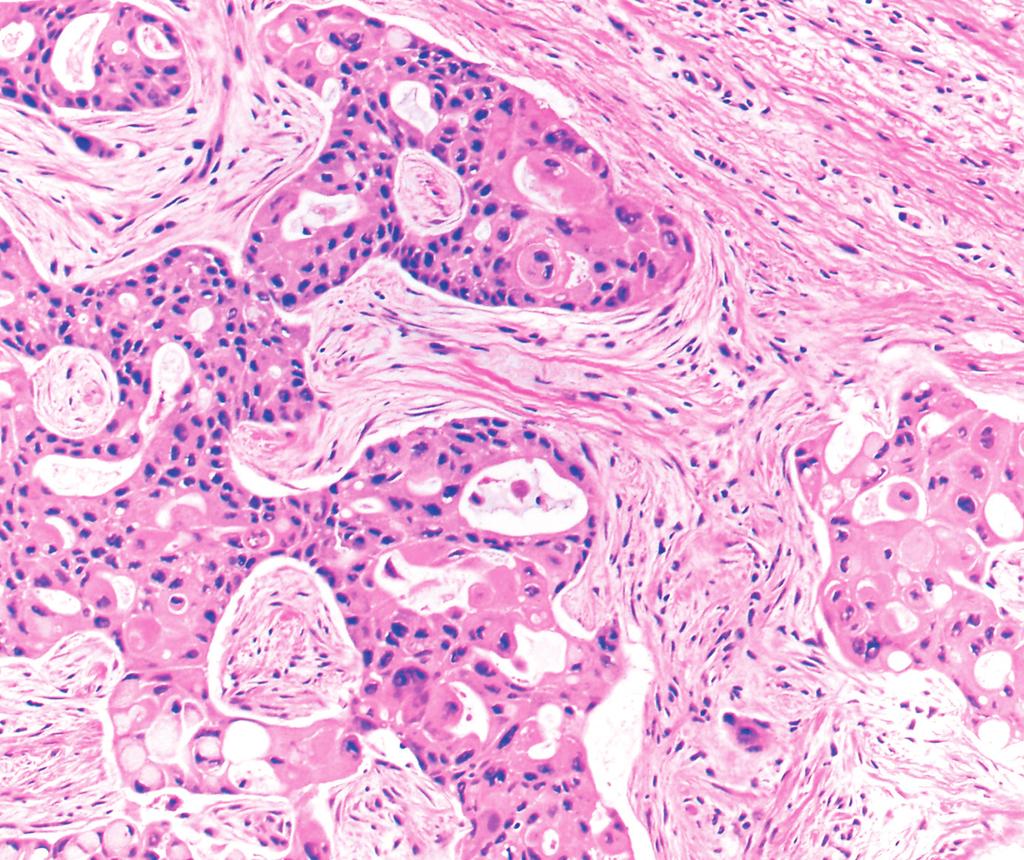 Like metastatic breast carcinoma, the tumor cells are strongly positive for GATA3 (C, 40) but negative for p63 (D, 40). usually expressed by invasive mammary carcinomas.