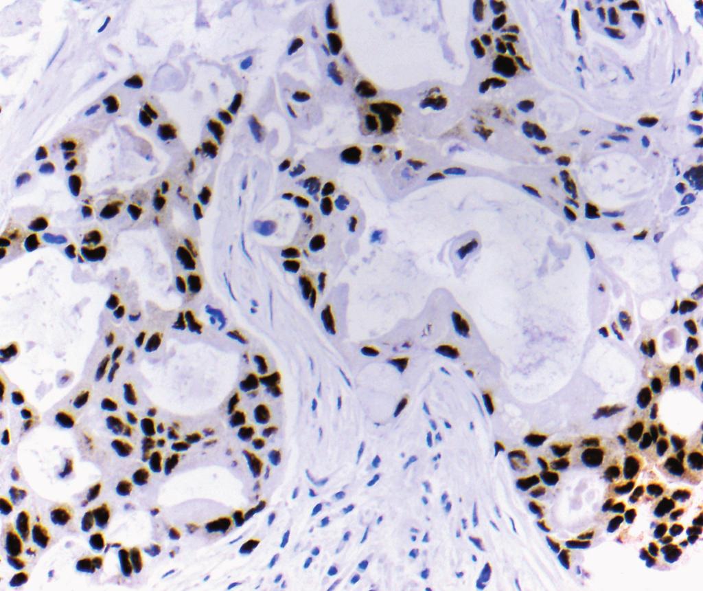 One cautionary note regarding the use of p63 is that it has also been observed in metaplastic mammary carcinomas,19 but the high-grade, sarcomatoid nature of those lesions makes it unlikely that they