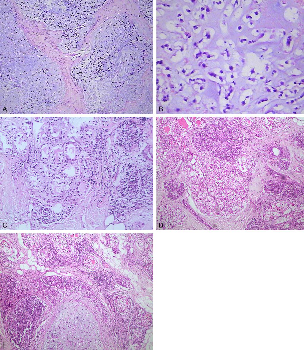 Figure 3. Histological findings of the tumor with H&E. A, B. MPC composed of cord-like cells were scattered in the chondromyxoid matrix (A 100; B 400); C.