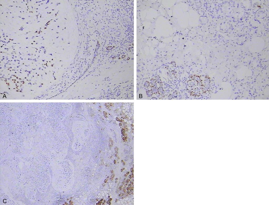 Figure 4. Immunohistochemical features of the tumor. A. Tumor cells of MPC exhibited p63 expression ( 200); B. Myoepithelial cells of MGA were negative for p63 ( 200); C.