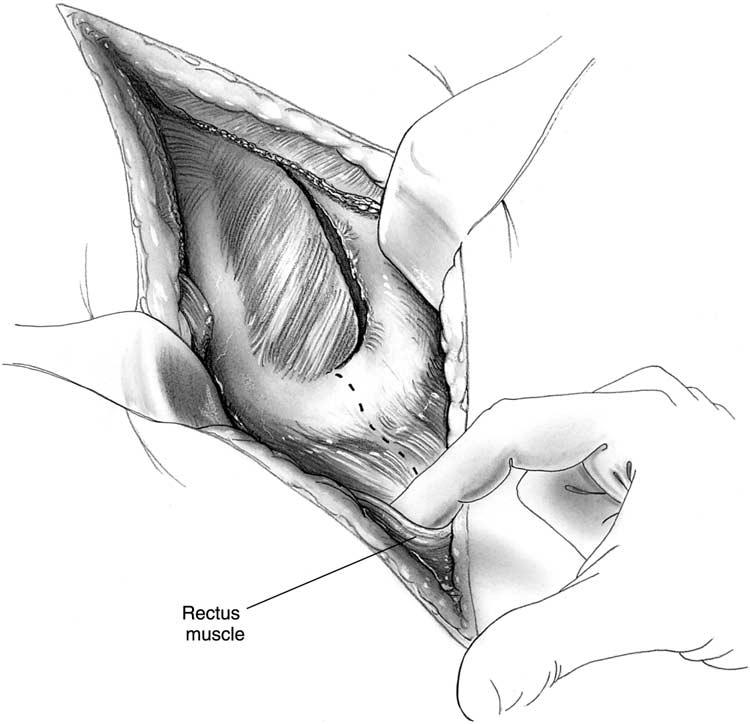 LEFT THORACOABDOMINAL INCISION 75 4 The chest is entered in the seventh intercostal space by dividing the intercostal muscles flush along the upper border of the eighth rib.
