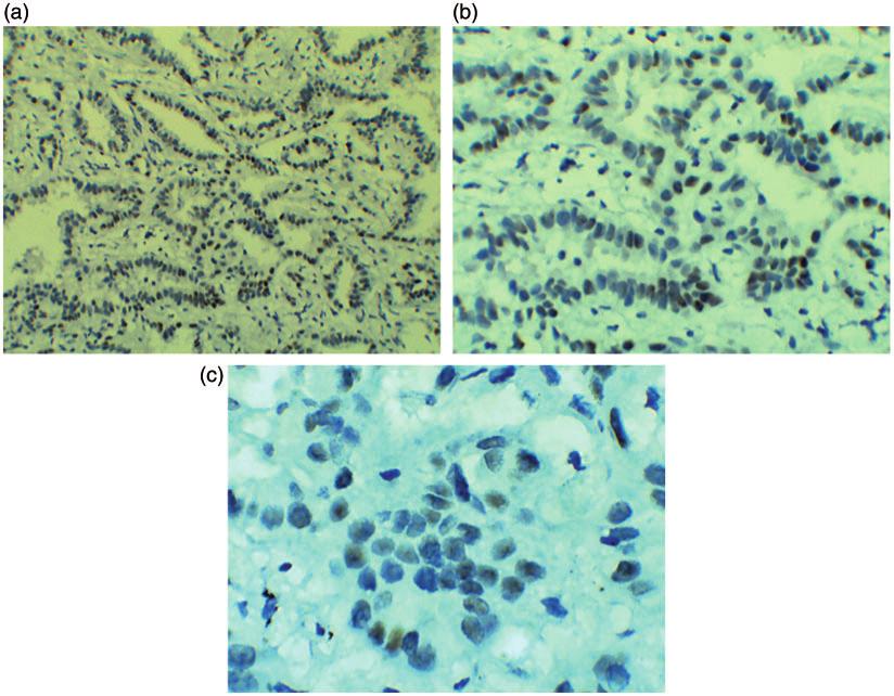 54 Journal of International Medical Research 45(1) Figure 1. ER expression in lung adenocarcinoma tissues: (a) 100, (b) 200 and (c) 400.