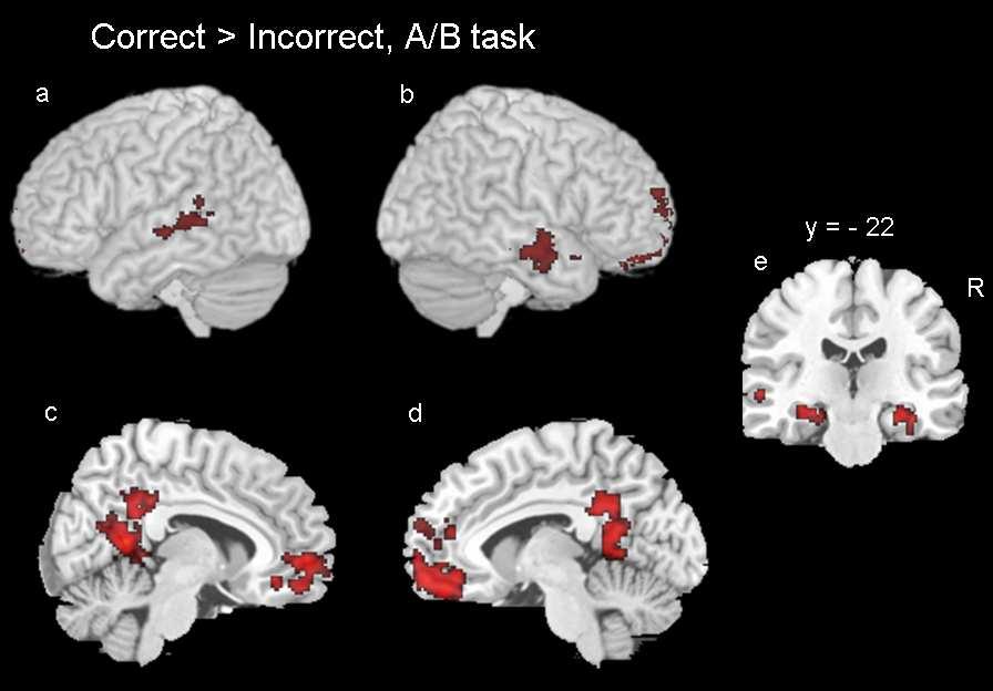 Brain region Size Max Z x y z A/B task (Whole brain cluster corrected) R Middle temporal (BA 21/22) 373 3.64 62-14 -16 L Middle temporal (BA 21/22) 263 3.