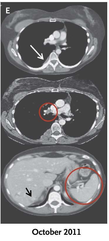 progression on anti-ctla-4 (ipilimumab) Palliative RT to spinal met