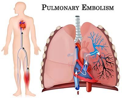 Deep vein thrombosis and pulmonary embolism (VTE) The risk of VTE is elevated in cancer (4 5% annually) Require