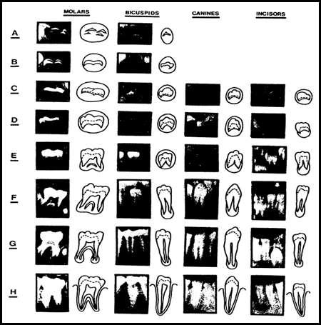 Maniar et al., Sch. J. App. Med. Sci., 2013; 1(5):423-426 Fig. 1: Developmental stages of the permanent dentition Fig. 2: The orthopantomogram showing permanent teeth in various stages of development.