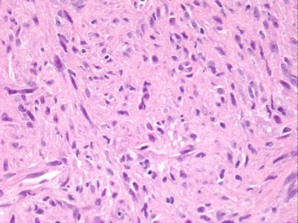 Histologically, dedifferentiated liposarcoma contains a well-differentiated liposarcoma component juxtaposed to areas of either low- or high-grade nonlipogenic sarcoma (dedifferentiation).
