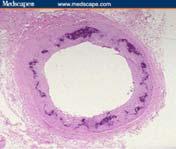 Atherosclerosis Intimal Calcification Uremic Arteriopathy - Medial Calcification