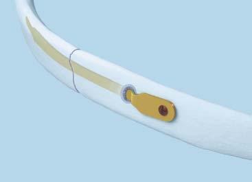 Locking plates Plates are precontoured to fit an average rib shape, which minimizes intraoperative bending 3 Locking plate construct provides stable fixation Low-profile 1.